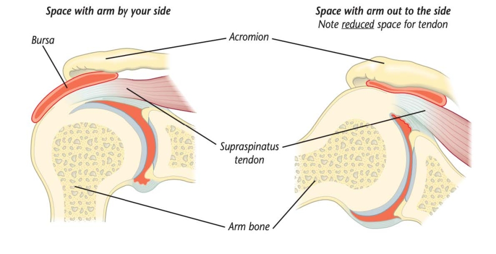 CotM #34 impingement syndrome1